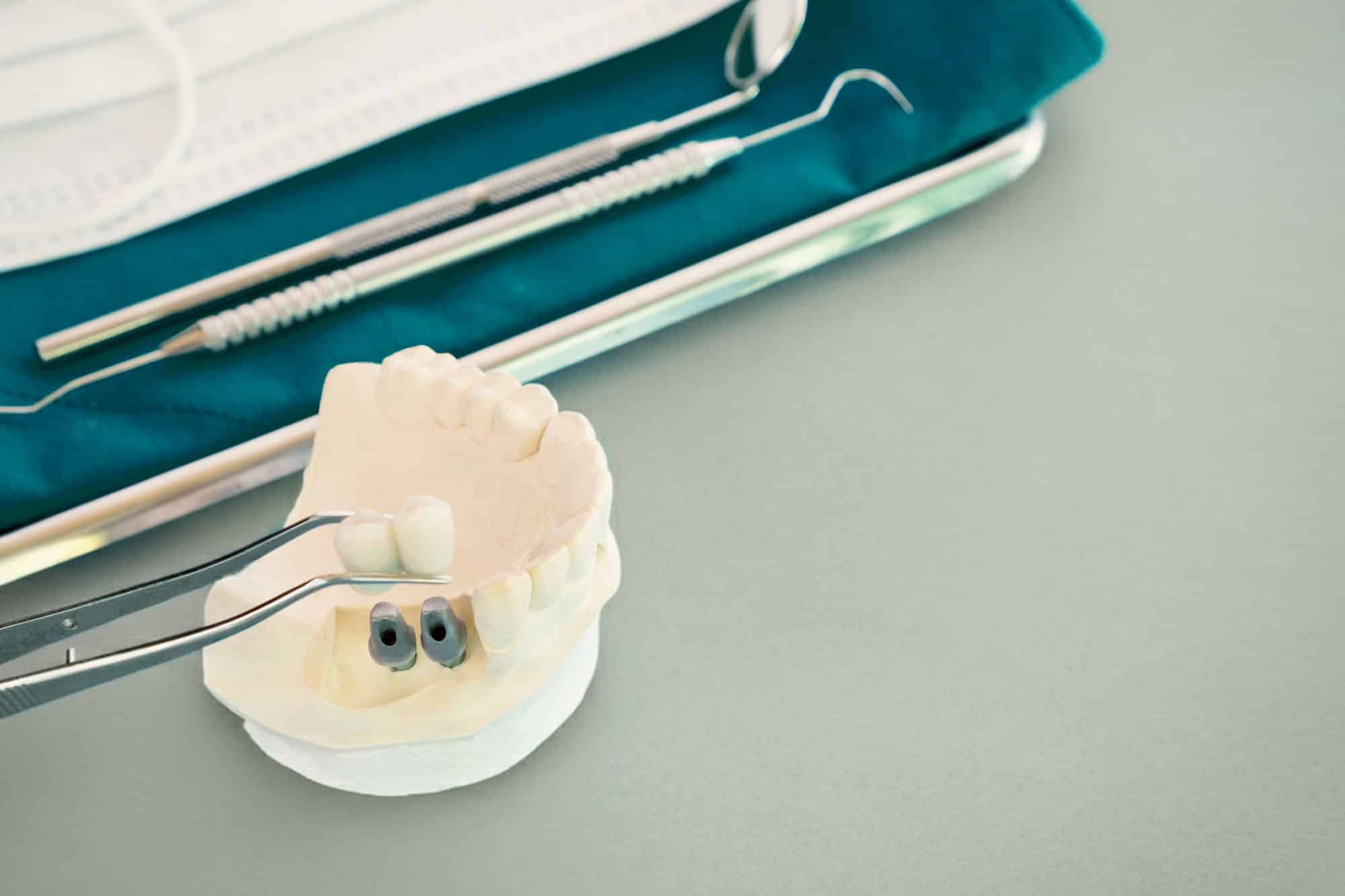 Dental Implants and Restorative Dental_colored