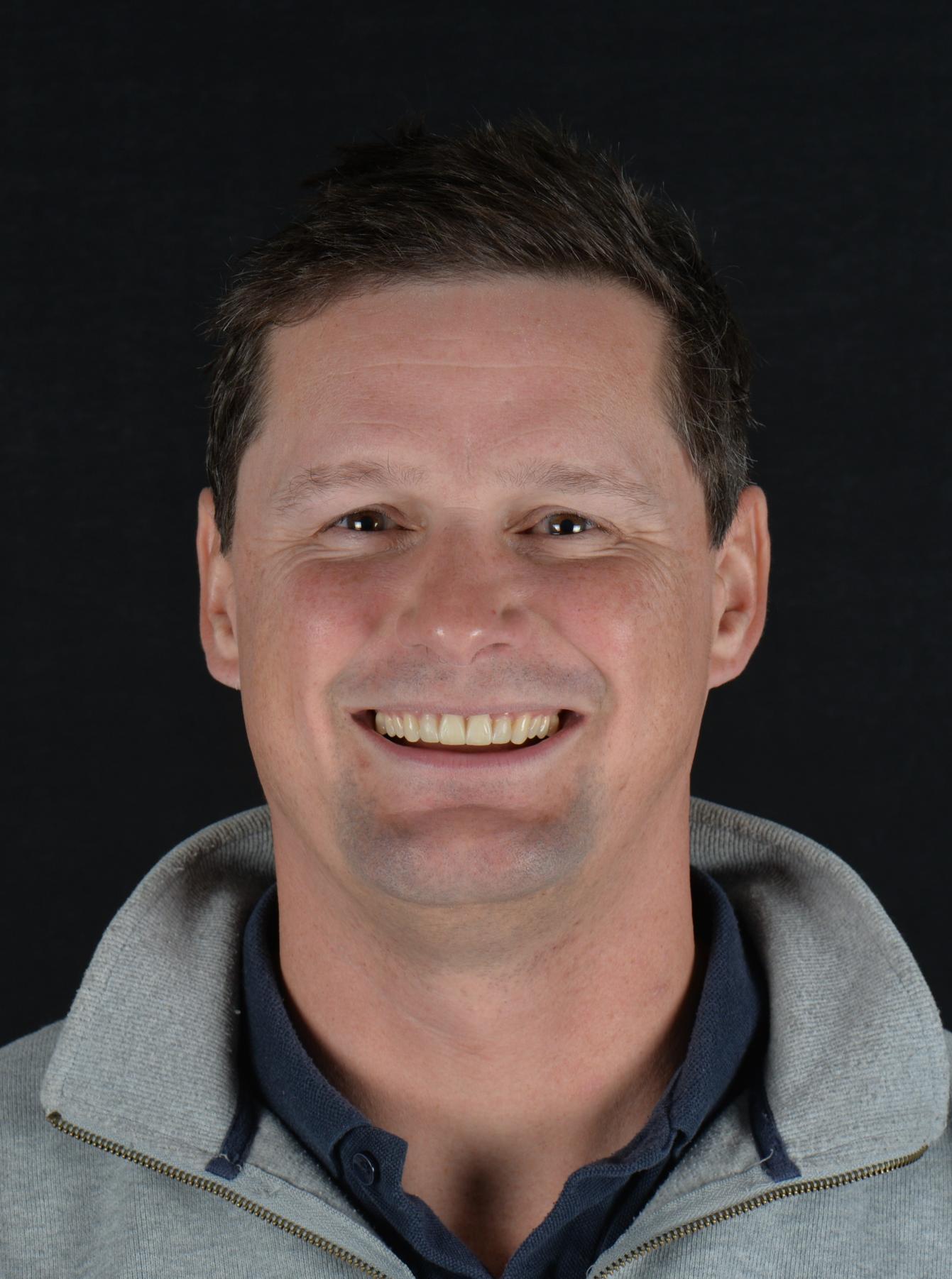 smile design - before & after - cosmetic dentist in adelaide - unley park dental