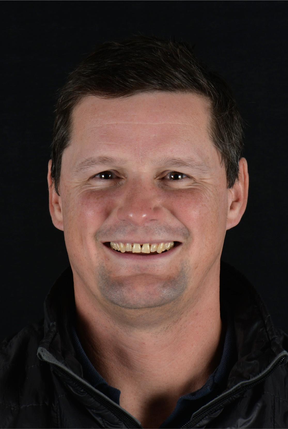 smile design - before & after - cosmetic dentist in adelaide - unley park dental