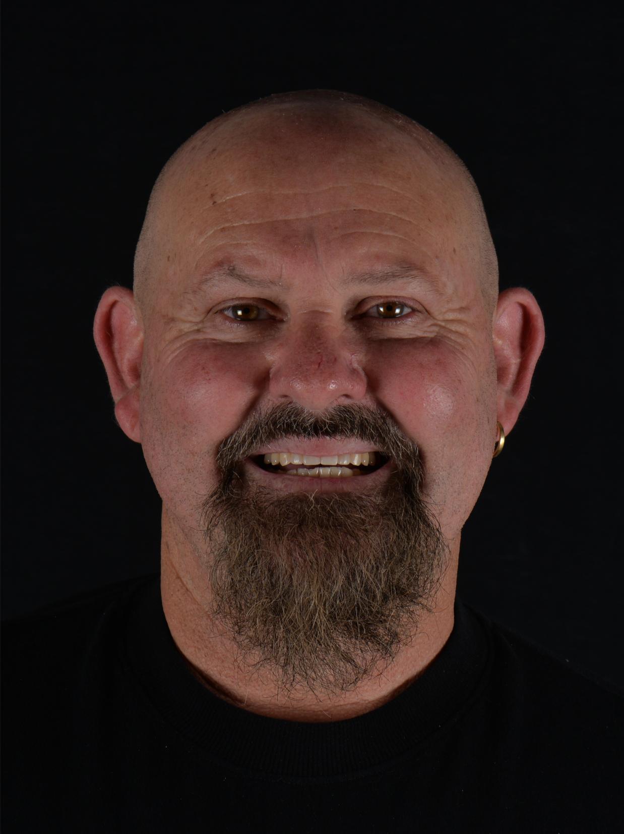 smile design - before & after - cosmetic dentist in adelaide - unley park dental