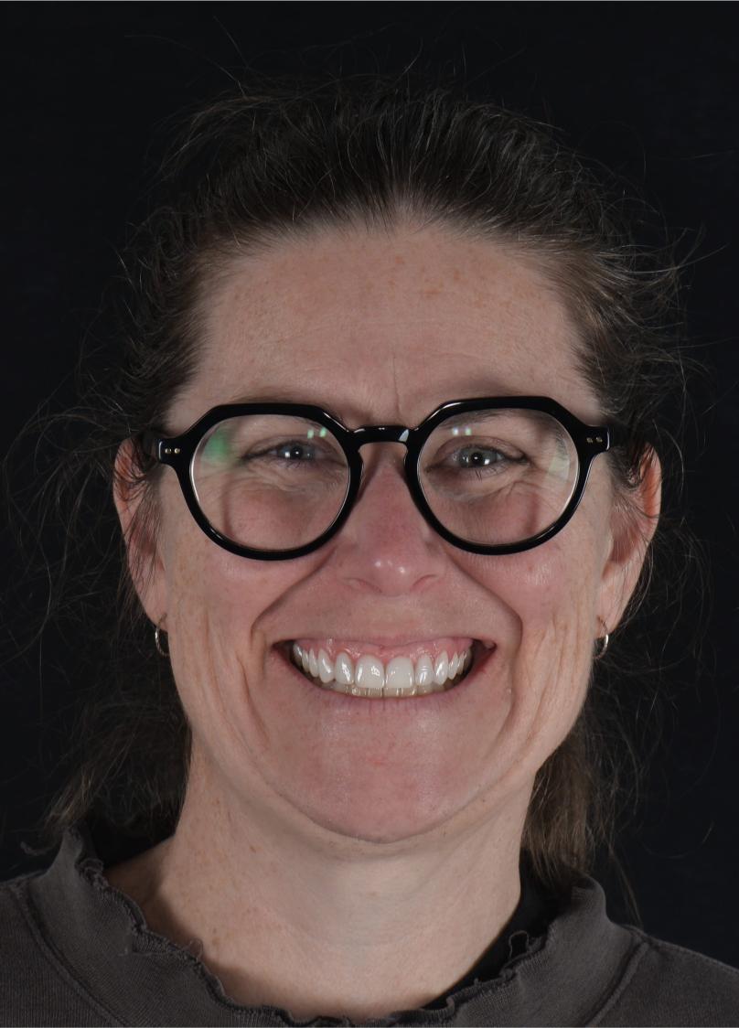 smile design - before & after - cosmetic dentist in adelaide - unley park dental