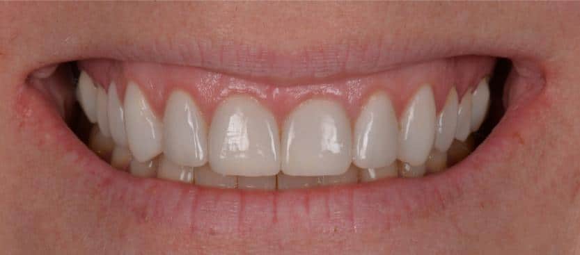 Penelope - Crown Lengthening - Close Up - After.jpg