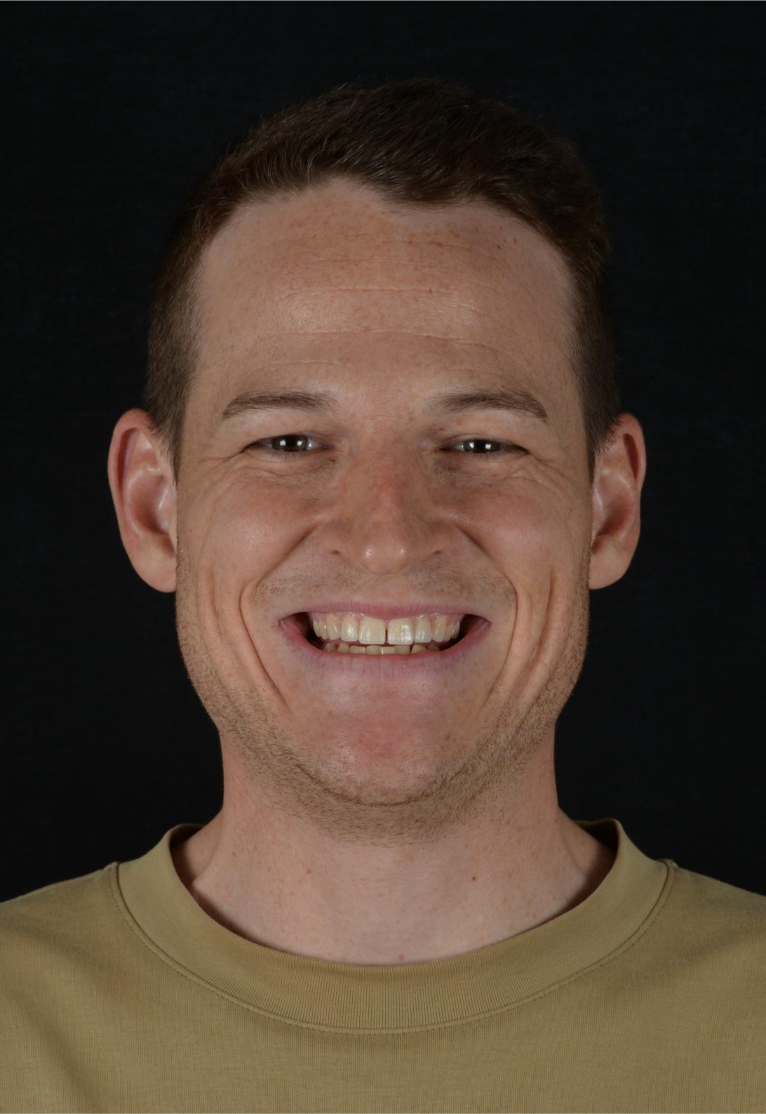 smile design - before & after - cosmetic dentist in adelaide - unley park dental