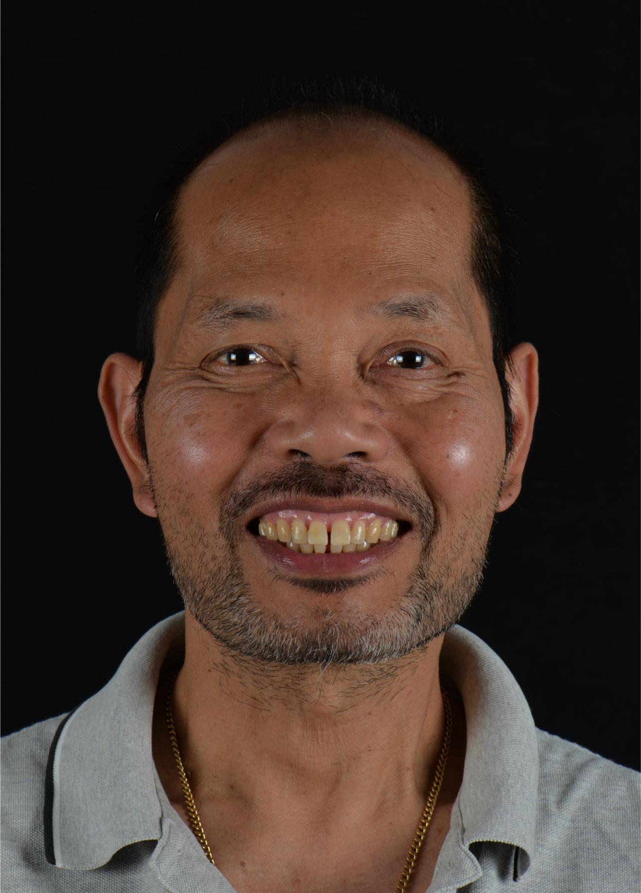 smile design - before & after - cosmetic dentist in adelaide - unley park dental