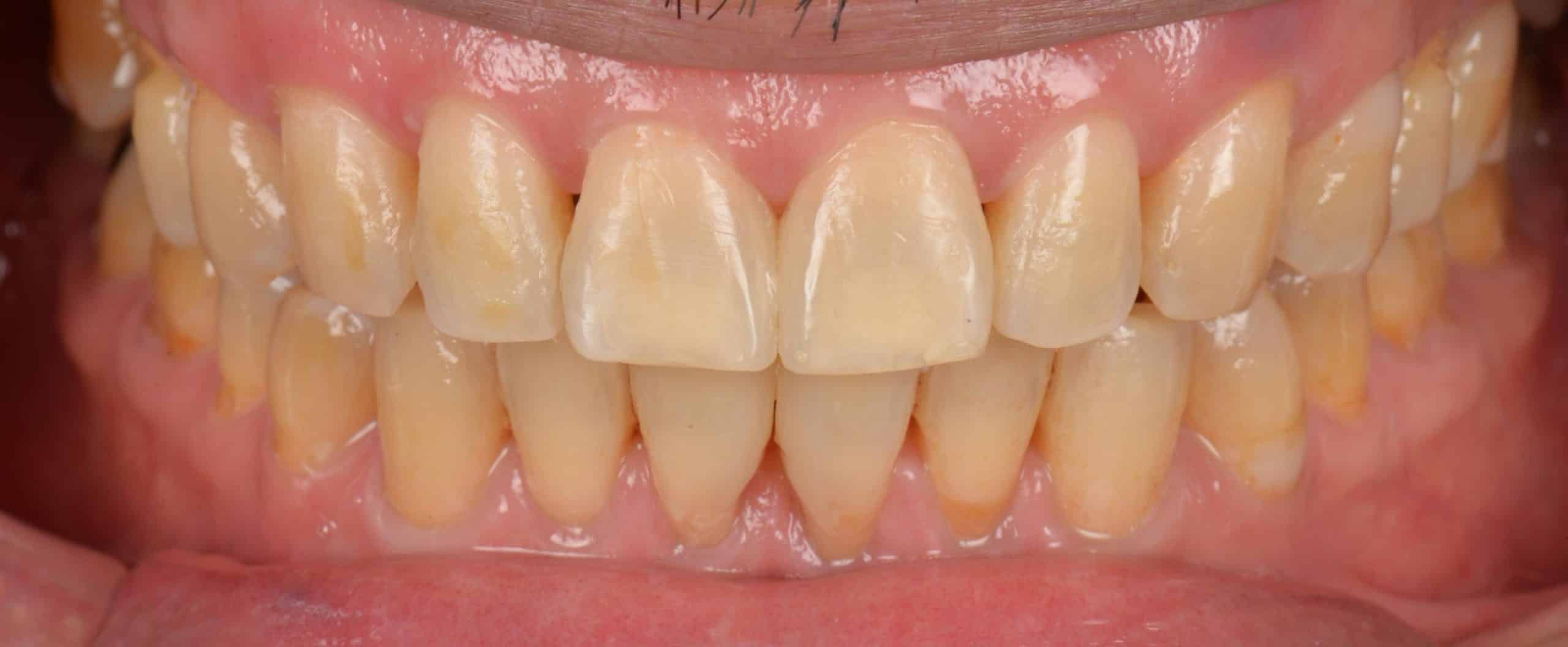 Rene - Layered Composite Bonding - Close Up - After