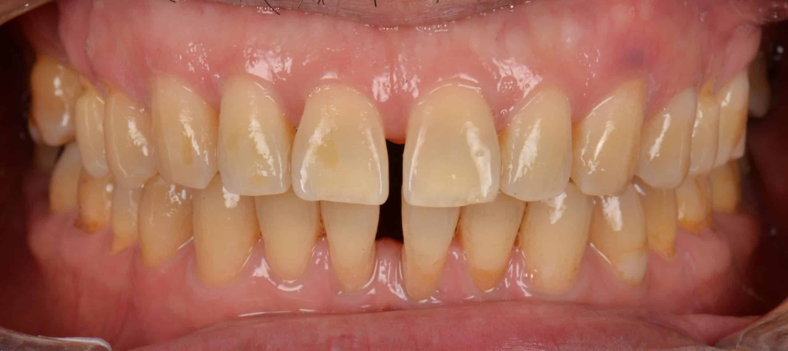 Rene - Layered Composite Bonding - Close Up - Before.jpg